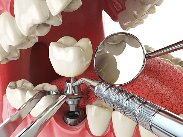 Best Emergency Root Canal Therapy in Riverton, IL